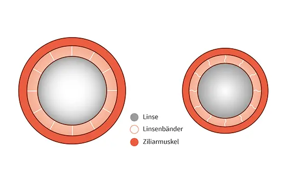 Linse bei Alterssichtigkeit