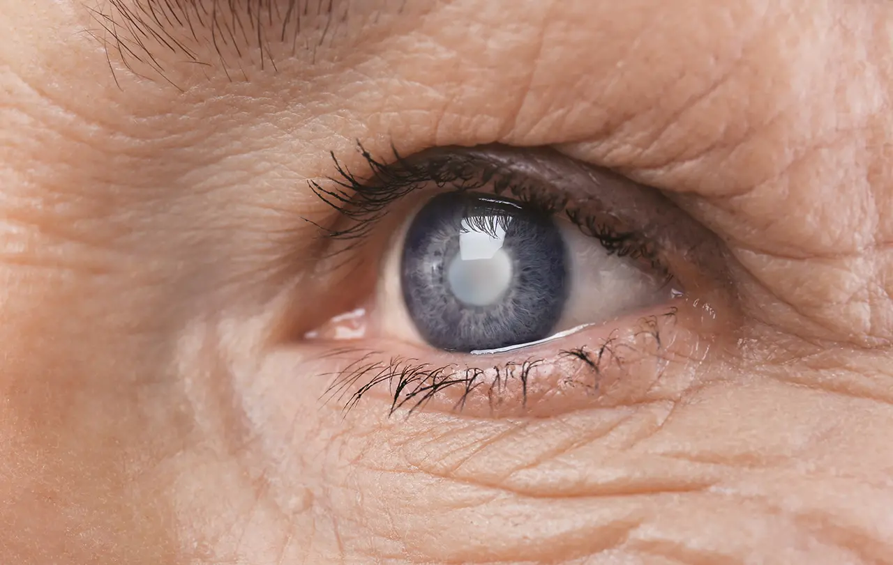 Bild vom Auge – Grauer Star