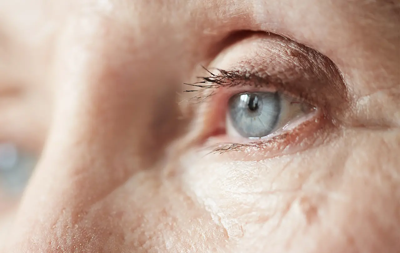 Auge mit Grünem Star (Glaukom)